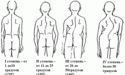 Берут ли в армию со сколиозом в 2025 году