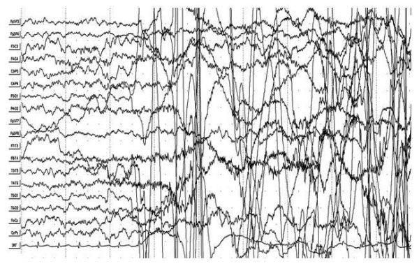 Эпилепсия