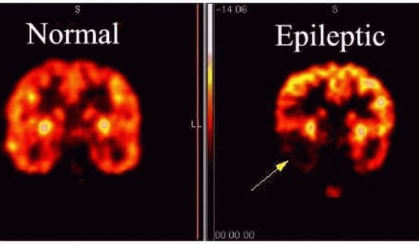 Формы эпилепсии