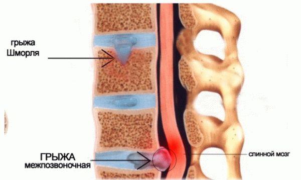 грыжа Шморля