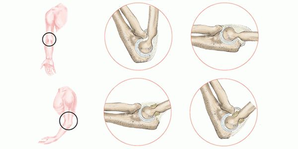 Операции на сухожилиях
