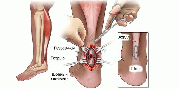 Операции на сухожилиях