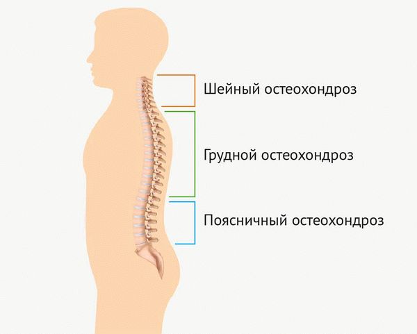 Виды остеохондроза