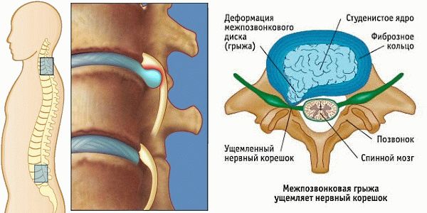 Грыжа диска в поясничном отделе наиболее распространенная