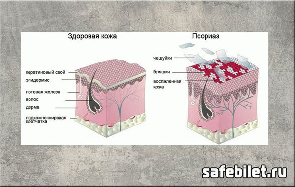 берут ли в армию с псориазом