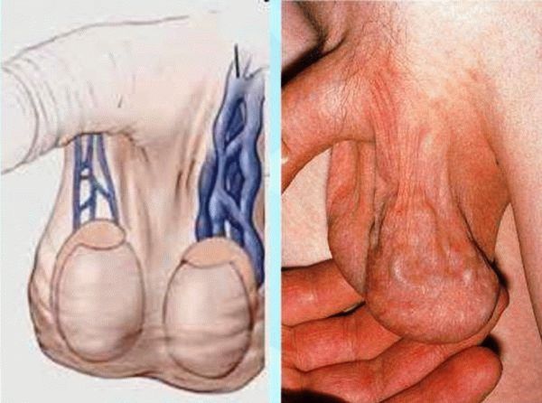 Варикоцеле