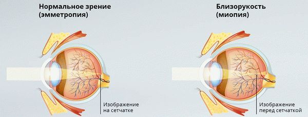 Изображение фокусируется перед сетчаткой глаза